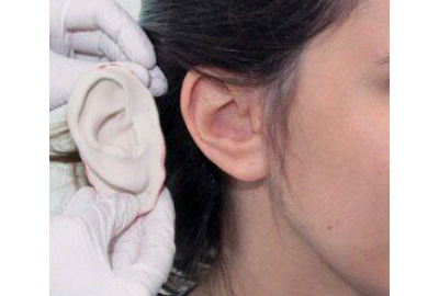 بعد از نصب پروتز زیبایی گوش در تبریز