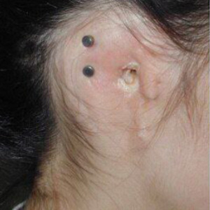 قبل از نصب پروتز زیبایی گوش در تبریز