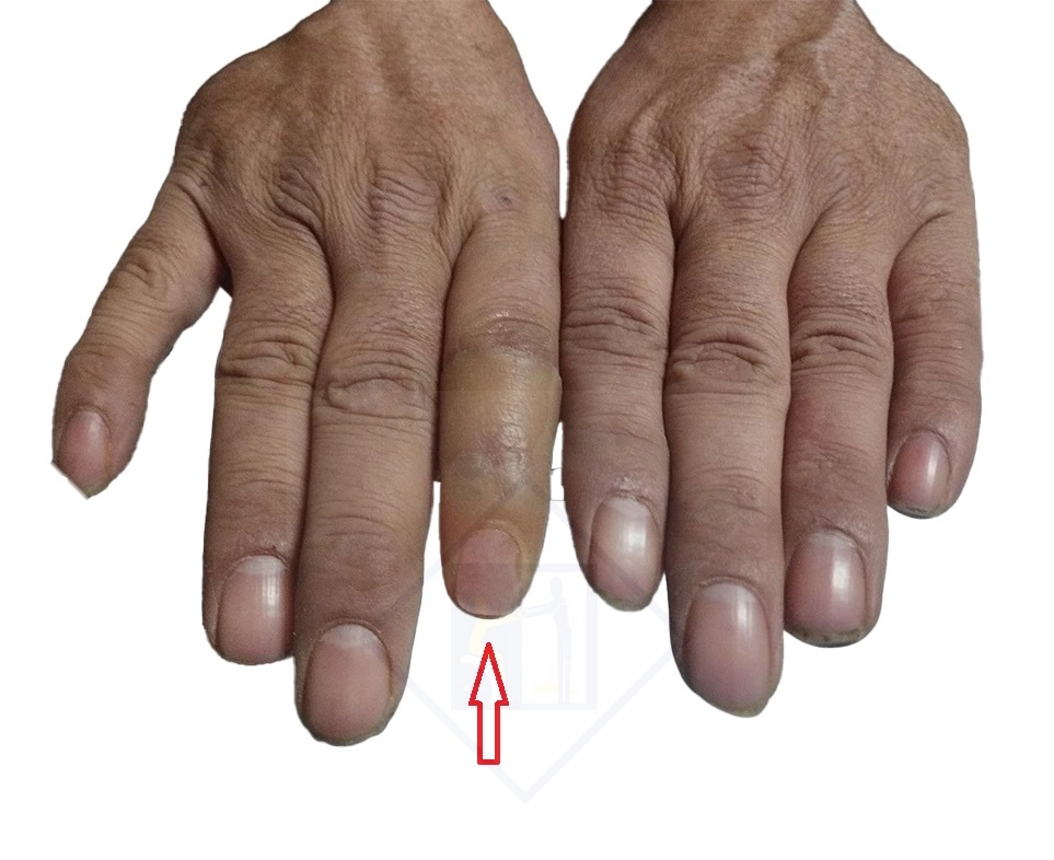 دست با پروتز - بعد از نصب پروتز زیبایی دست و انگشت در تبریز