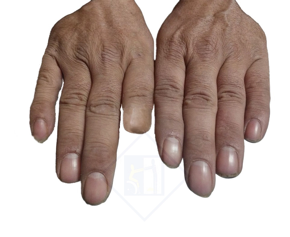 دست بدون پروتز - قبل از نصب پروتز زیبایی دست و انگشت در تبریز