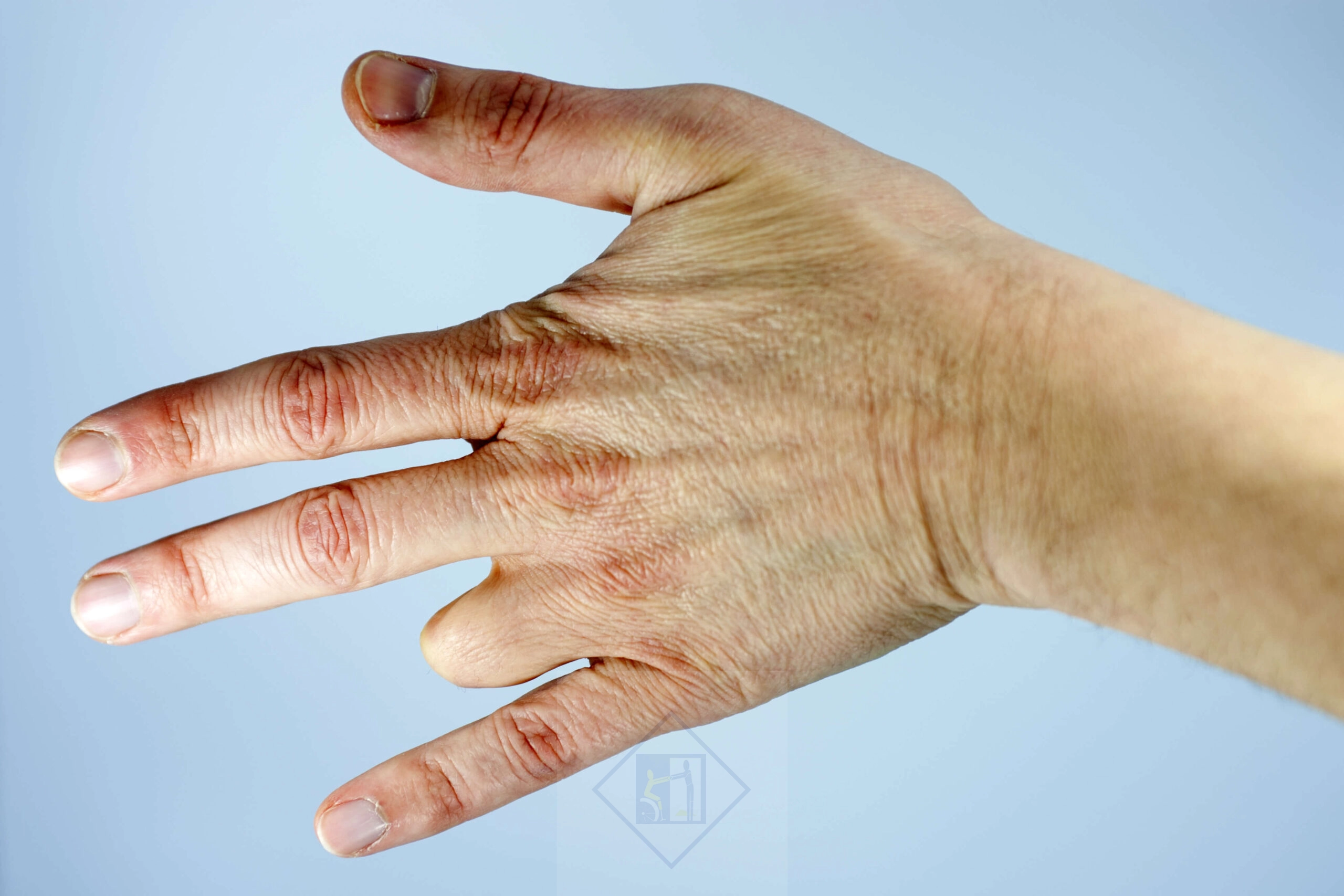 تصویر پروتز دست سیلیکونی